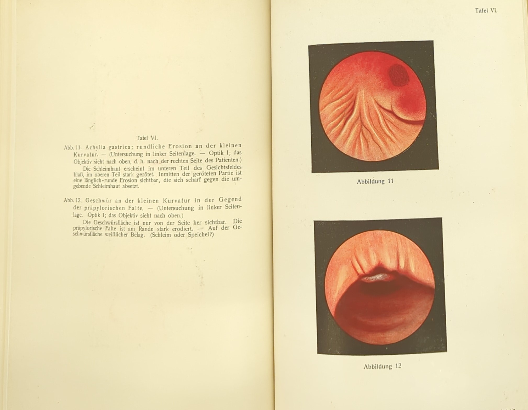 Ausschnitt aus:  Dr. Hans Elsner  Die Gastroskopie. Thieme Verlag Leipzig 1911. Quelle: Staatsbibliothek Berlin